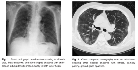 radiograph and computed tomography showing lung damage caused by an environmental fungus