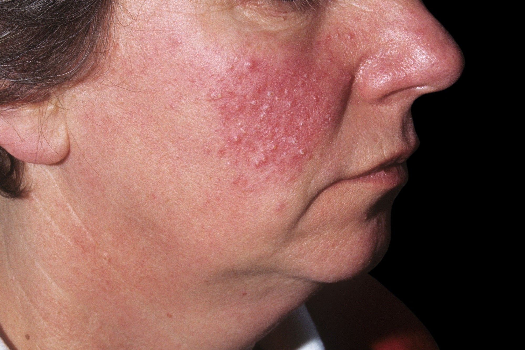 steroid rosacea