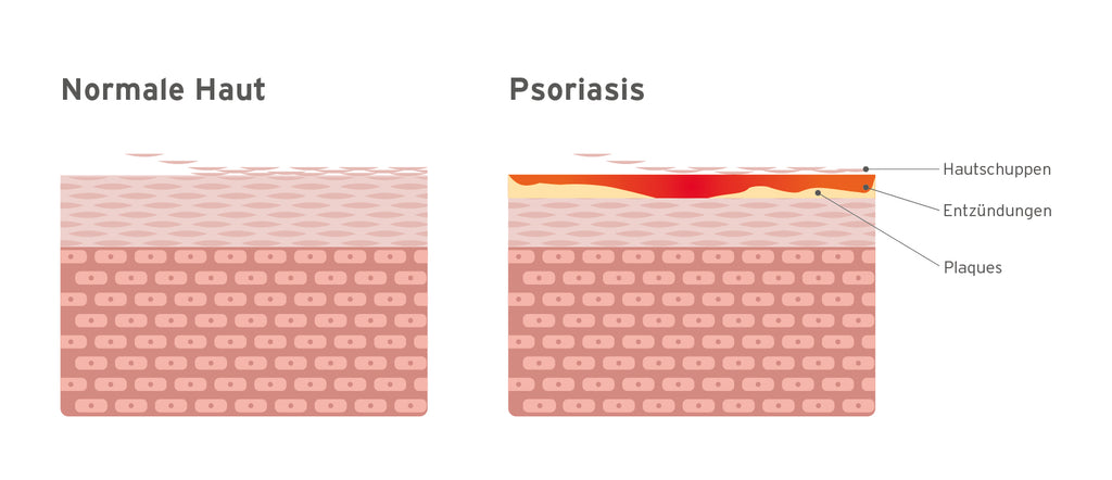 Vergleich_gesunde_Haut_Psoriasishaut