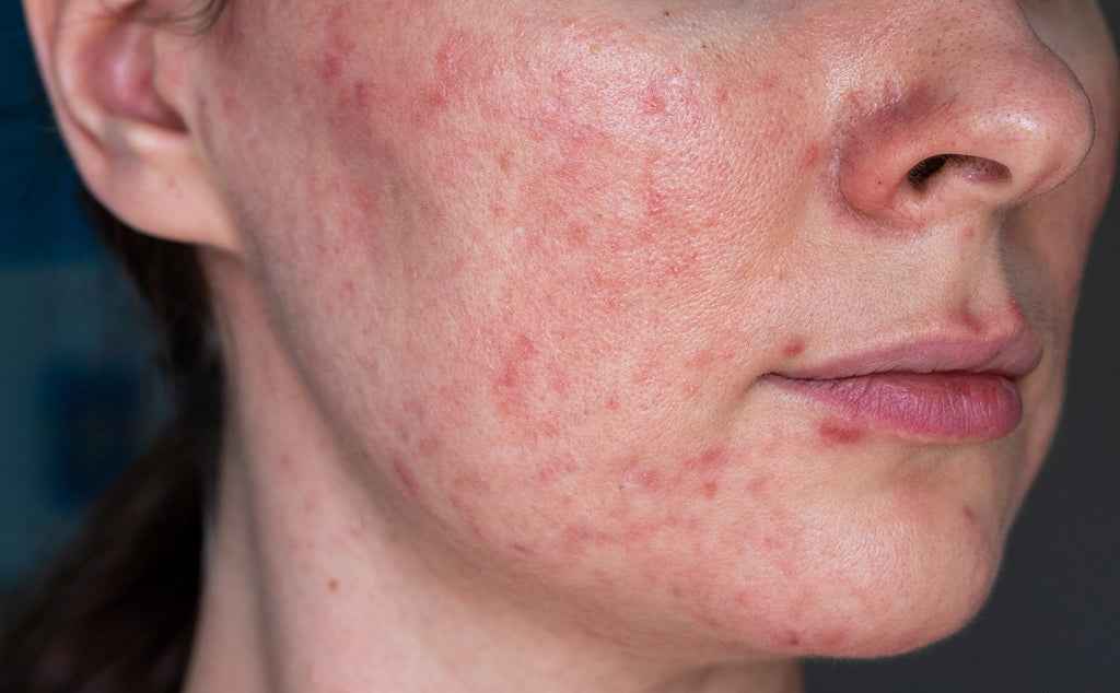 Rosacea-Symptome an Wangen- und Kinnpartie