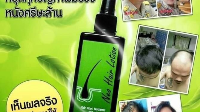 #1 Best Neo Hair Lotion No Side Effects Hair Growth Oil