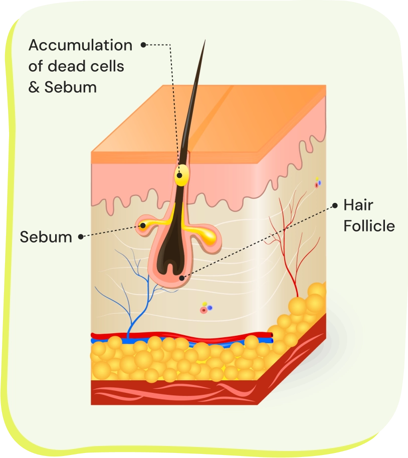 Acne Breakout 2.webp__PID:dfe4c188-10a0-41b8-b3e5-93f4777deb45