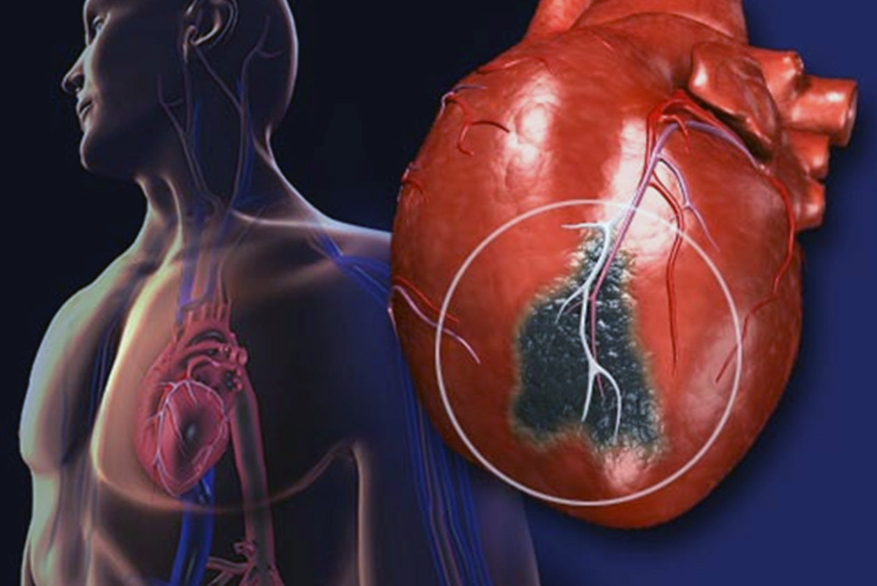 Язва сердца. Инфаркт миокарда сердце. Патологии сердца инфаркт миокарда. Ишемическая болезнь сердца инфаркт миокарда.