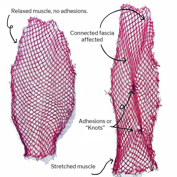 Fascia Adhesions