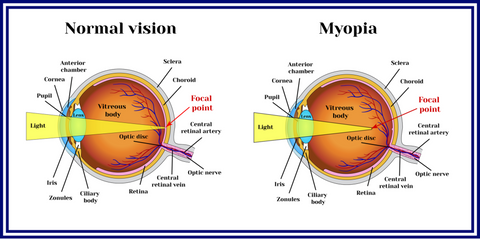 Myopia