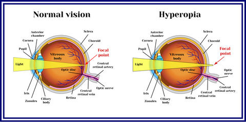 Hyperopia