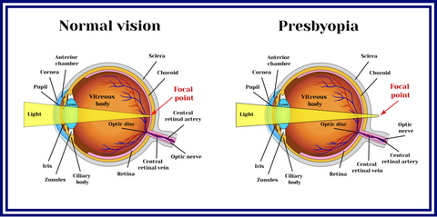 Presbyopia