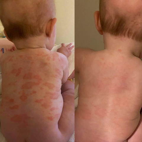Before and after psoriasis 