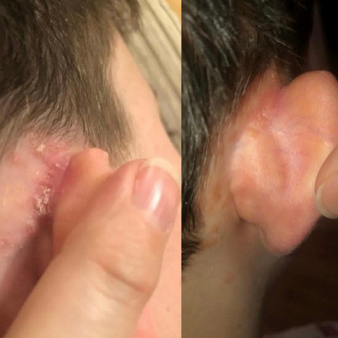 Scalp psoriasis before and after