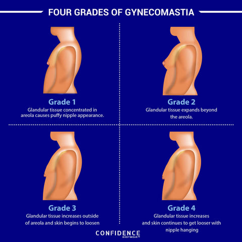 Four Stages of Gynecomastia