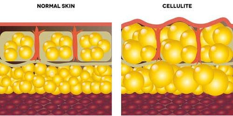 illustration of cellulite-fatty skin-www.rdalchemy.com