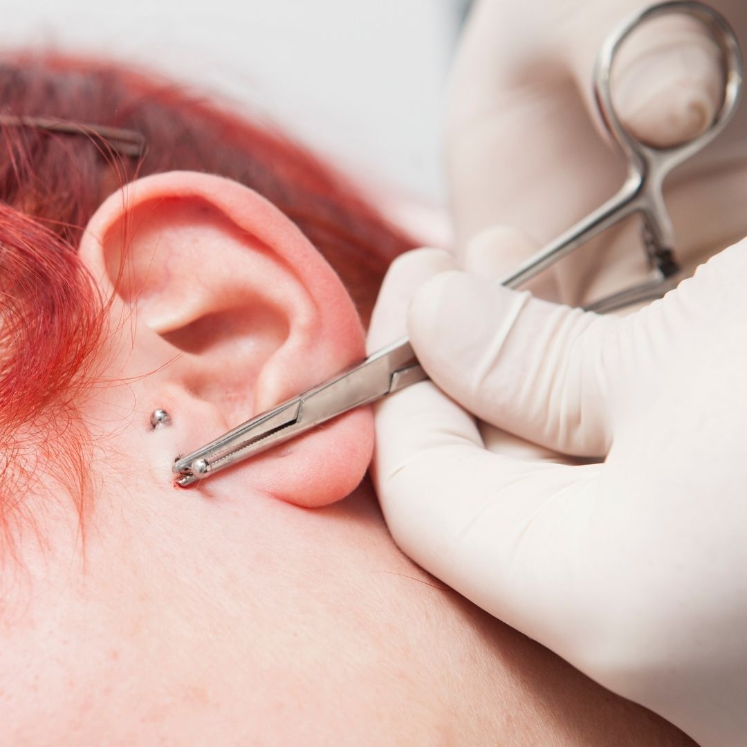 Hole in ear (preauricular pit): What to know