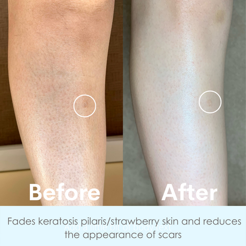 Fades the appearance of Keratosis Pilaris and Strawberry skin