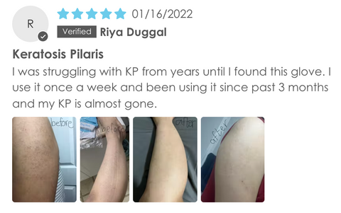 Keratosis Pilaris Before and After