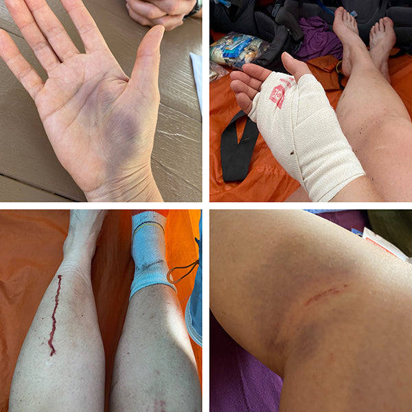 Catherine Grisez hiking injuries on the Appalachian Trail