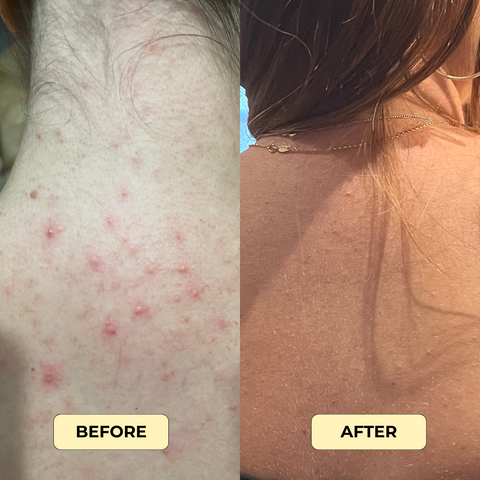 "Before and after photo showing body breakouts on the back, with significant improvement in skin clarity and texture after using our targeted body acne treatment."