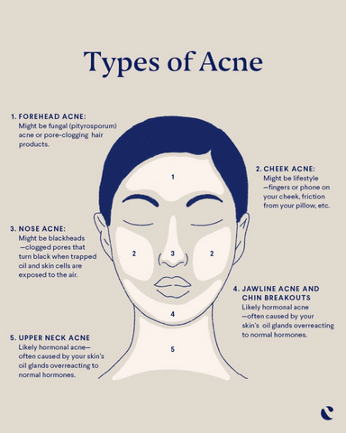 hormonal acne