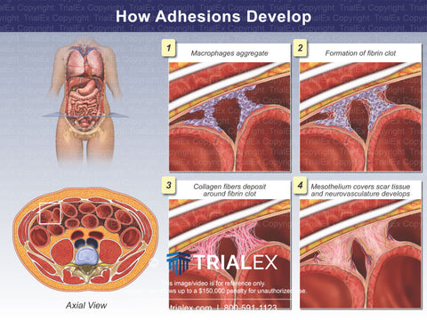 how adhensions develop