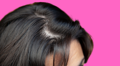 Close up of a woman's hair experiencing alopecia