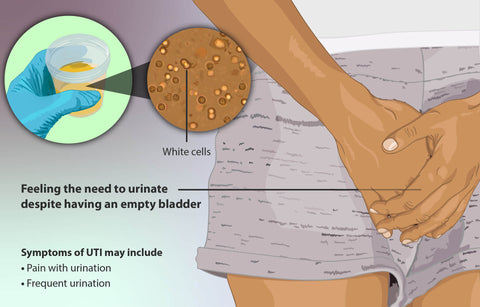 UTIs From Masturbation