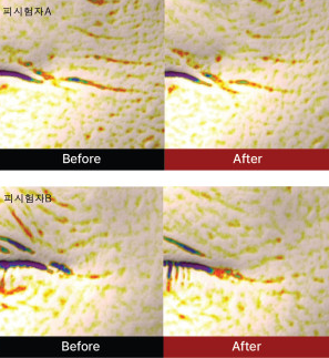 before-after-wrinkle-histologica-retinol-cream