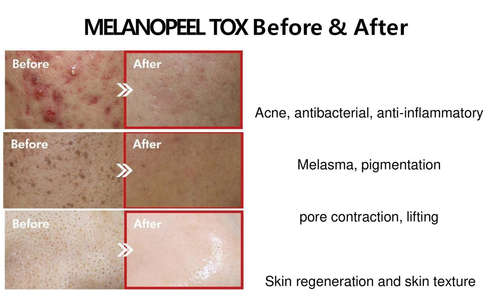 derma maison melano peel