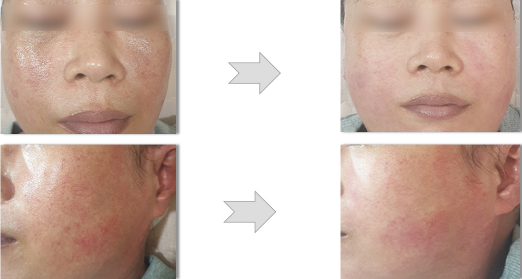 dermathod-derma-level-345-before-and-after