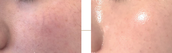 rebl-synergy-ampoule-before-after