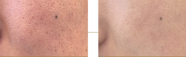 rebl-synergy-ampoule-before-after