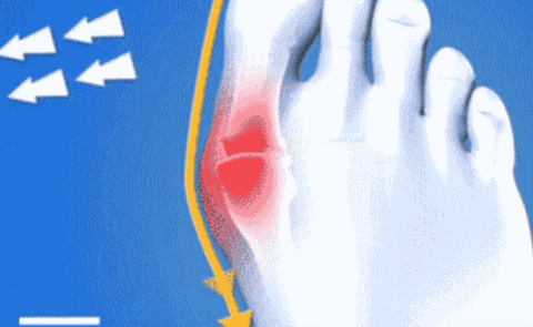 Bunions: Causes, Symptoms, and Treatment. – fayybek