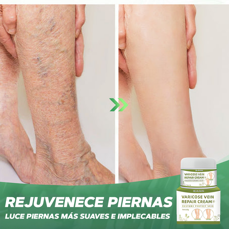 Crema para Varices - HealthySkin™