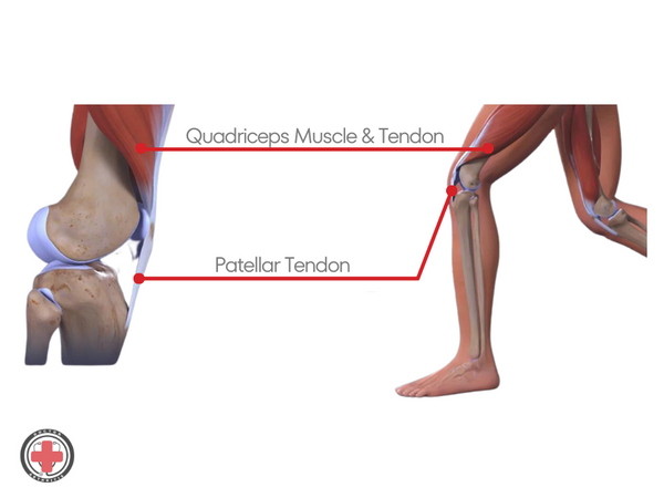 Quadriceps Tendonitis