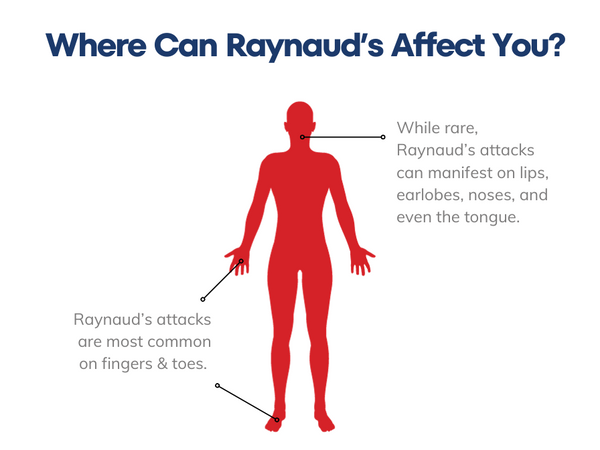 heated gloves for raynaud's