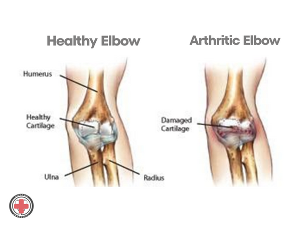 elbow arthritis vs healthy elbow