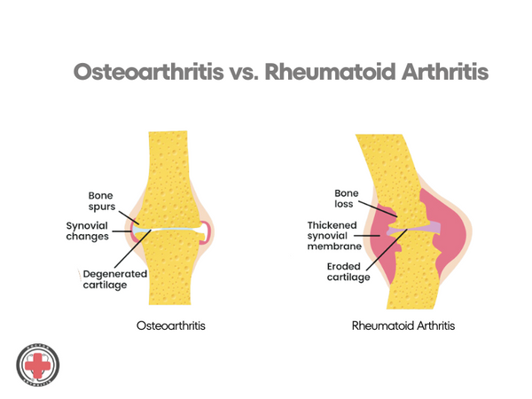 rheumatoid arthritis wiki_OA vs RA