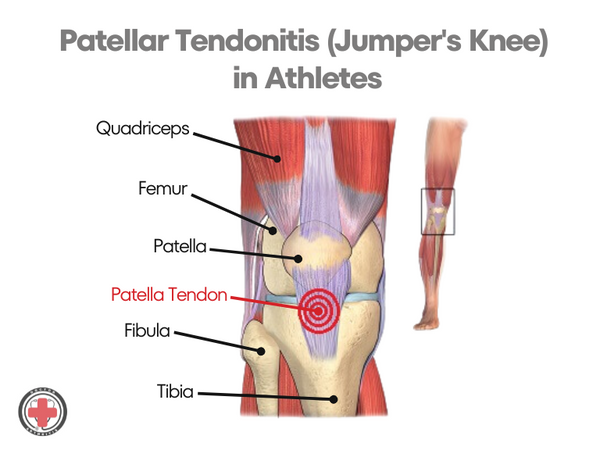 What Type of Knee Brace is Best for Tendonitis_Jumper's Knee