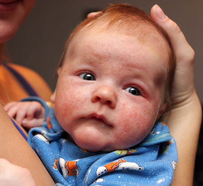 Cómo identificar tu bebé tiene dermatitis atópica | Mustela