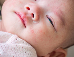Un bebé con un brote de dermatitis atópica en la cara