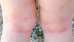 Placas de eccema en el pliegue de las rodillas de un niño