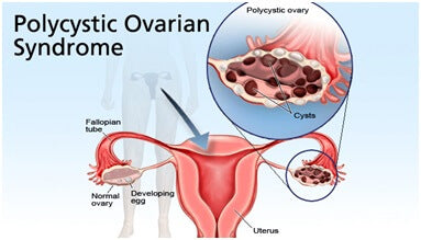 PCOS-PCOD-Treatment