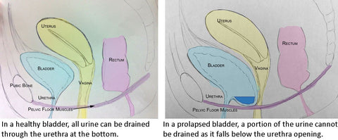 Heal Leaky Bladder or Bladder Prolapse Naturally and Safely – NeuEve