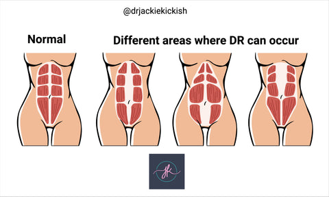 Diastasis Recti 101 – Dr. Jackie Kickish