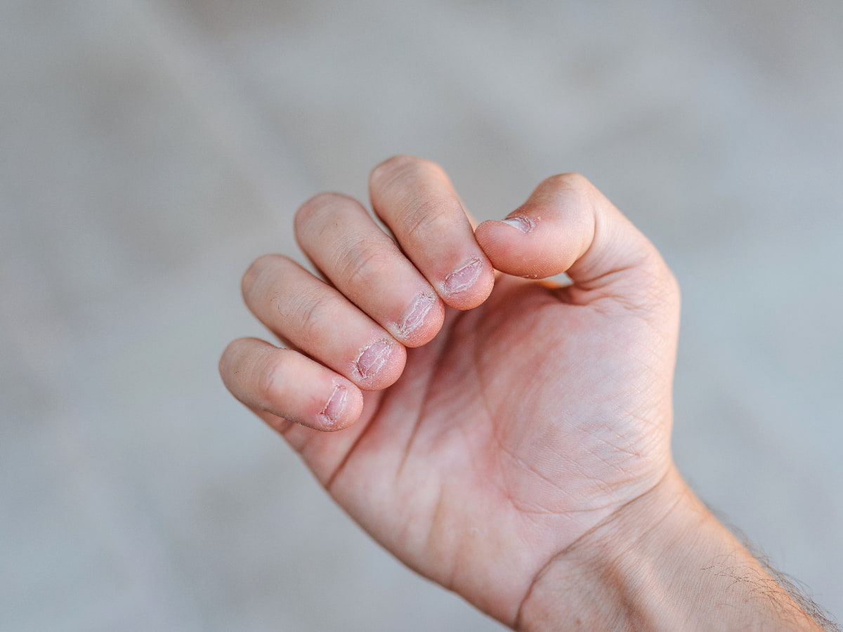 Candida Overgrowth in Nails