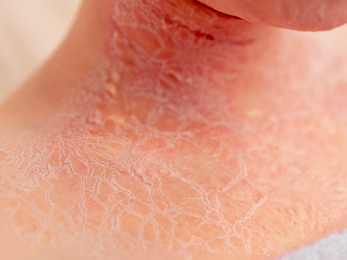 The Influence of Sulphites on Dermatological Conditions