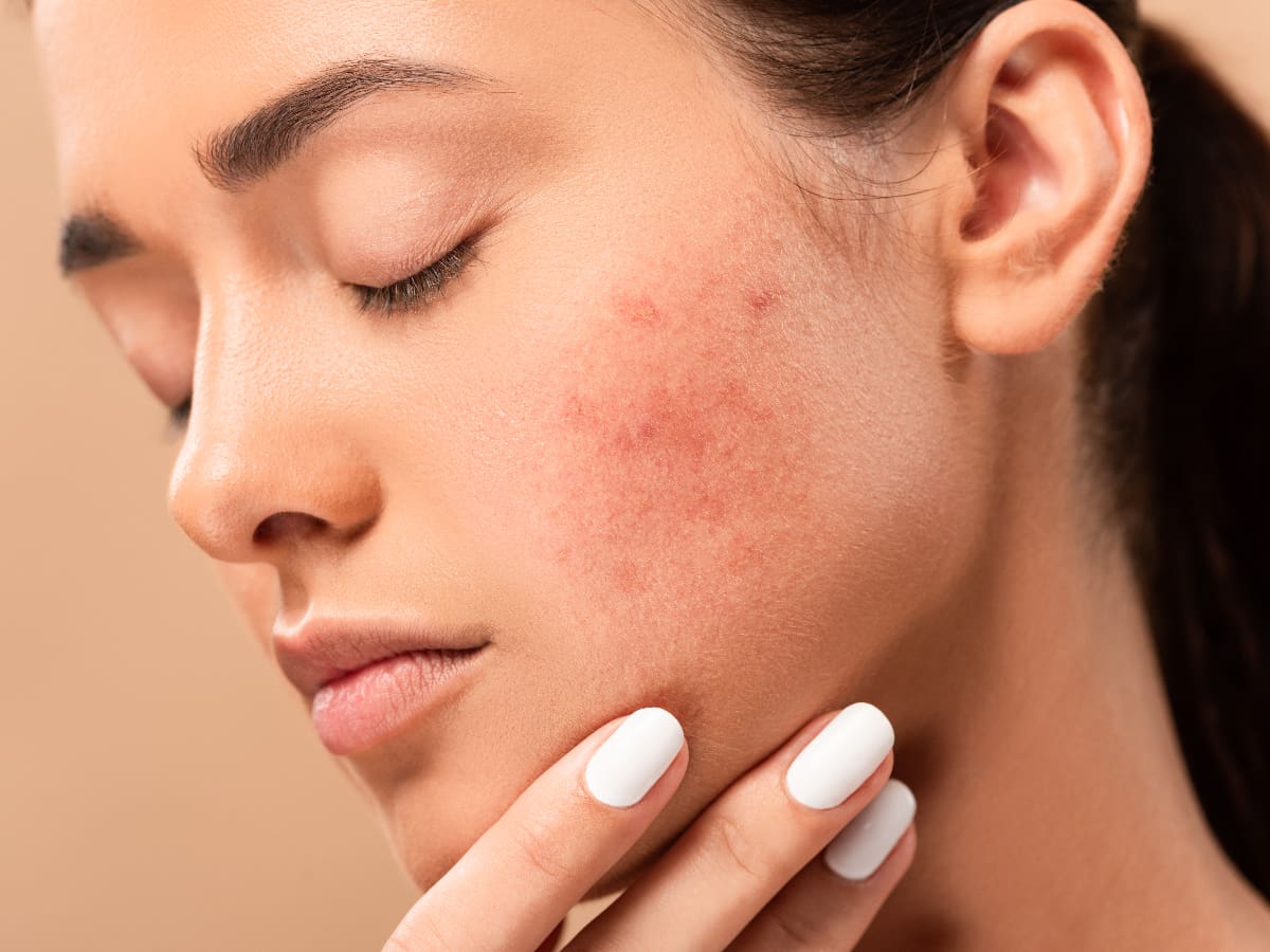 skin issues like acne, eczema, and dullness