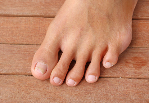 Toenail Fungus Relief With Structured Silver Gel - Ameo Life