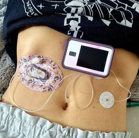 A dexcom g6 with patch being worn next to a T:Slim X2 insulin pump with sticker, and infusion set