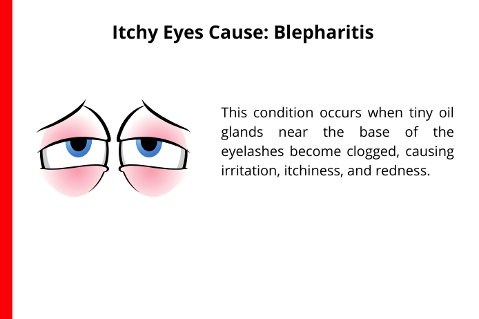 blepharatis as a common cause for itchy eyes