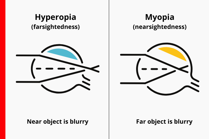 nearsighted versus farsighted vision definition