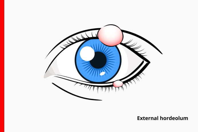 external eye stye also known as external hordeolum